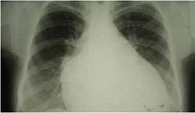 Рис. 4. Рентгенография грудной клетки больной Б. при поступлении в стационар