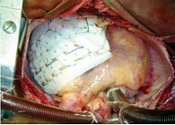 Рис. 6. Операция имплантации экстракардиального сетчатого каркаса больной Б.