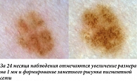 Рис. 17. Меланома кожи, поверхностно-распространяющаяся форма.