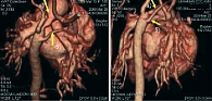 Рис. 5. РКТ с VRT-реконструкцией на десятые сутки жизни: перерыв дуги аорты, аберрантная (ретроэзофагальная) правая подключичная артерия (б), артериальный проток (а)