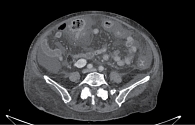 Рис. 4. Компьютерная томография органов брюшной полости на третьи сутки