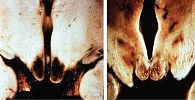 Рисунок. Двусторонний некроз мамиллярных тел при энцефалопатии Вернике – Корсакова