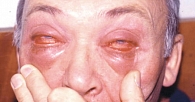 Рис. 4. Пациент с АВКК, осложненным токсико-аллергической реакцией, возникшей на фоне применения мази Бонафтон в течение десяти дней