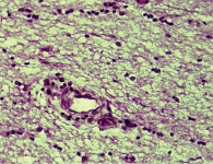 Рис. 8. Пролиферация вокруг сосудов лимфоидных клеток и макрофагов (окрашивание гематоксилином и эозином, увеличение 10 × 40)
