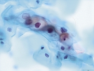 Рис. 2. Цитологическая картина эпителия шейки матки, соответствующая LSIL