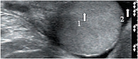 Рис. 5. Эхограмма неизмененного яичка ребенка 8 лет. 1 – яичко в поперечном срезе, 2 – жидкостное содержимое серозной полости