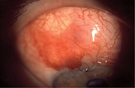 Рис. 5. Состояние правого глазного яблока на первые сутки после хирургического вмешательства