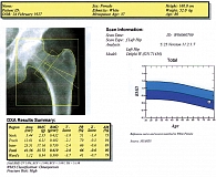 Рис. 3. Результаты измерения минеральной плотности проксимального отдела бедренной кости