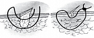 Рис. 1. Вертикальный П-образный шов