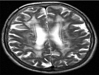 Рис. 2. Данные МРТ головного мозга