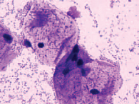 Рис. 4. Микроскопическая картина при промежуточном типе влагалищного мазка. По результатам ПЦР-диагностики – выраженный дисбиоз