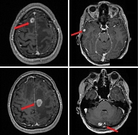 Рис. 5. МРТ головного мозга от октября 2019 г.