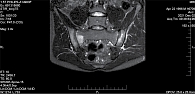 Рис. 1. Магнитно-резонансная томограмма КПС пациента К. в режиме STIR за декабрь 2021 г. (определяются очаги острого костномозгового воспаления в области обоих суставов (гиперинтенсивные сигналы) в режиме жироподавления)
