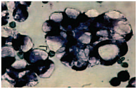 Рис. 3. Крупные оптически «пустые» вакуоли при серозном раке яичника. Окрашивание по Паппенгейму, увеличение  в 400 раз