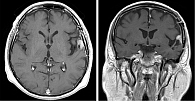 Рис. 4. МРТ головного мозга от февраля 2024 г.: максимальный регресс опухоли до размеров 9 × 10 × 5 мм, без признаков перифокального отека
