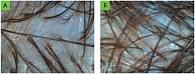 Рис. 1. Трихоскопия волосистой части головы: А – до лечения, Б – после лечения