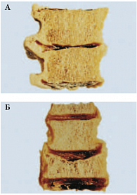 Рис. 1. Остеопороз позвоночника: а) нормальная кость, б) кость при остеопорозе
