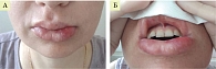 Рис. 5. Постепенный регресс клиники мукозита: А – уменьшение отека тканей губ; Б – восстановление тканей слизистой оболочки