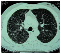 Рис. 1. Клинический случай 1. Диссеминация в сочетании с интерстициальными изменениями при рентгеновской компьютерной томографии (РКТ) органов грудной клетки у больного саркоидозом
