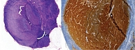 Рис. 2. Метастаз беспигментной меланомы кожи в СЛУ, подтвержденный результатами иммуногистохимического исследования (S100)