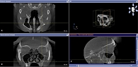 Рис. 1. 3D-КТ околоносовых пазух в трех проекциях (остеома левой верхнечелюстной пазухи)