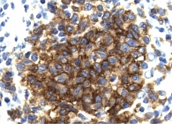 Рис. 4. Иммуногистохимия на CD1a: сильное положительное окрашивание клеток Лангерганса (исходное 630-кратное увеличение)