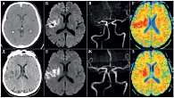 Рис. 4. Данные визуализационного исследования головного мозга пациента С., 67 лет: а, д – рентгеновская компьютерная томография; б, е – магнитно-резонансная томография; в, ж – магнитно-резонансная ангиография; г, з – карты измеряемого коэффициента диффузи