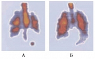 Рис. 1. Депозиция частиц лекарственного вещества и его распределение в легких при ингаляции препарата с помощью ДАИ (а) и ПИ Изихейлер (б)