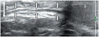 Рис. 13. Мошоночная часть семенного канатика пациента 11 лет. Продольное сканирование. Стрелками указан семявыносящий проток. 1 – яичко, 2 – семенной канатик