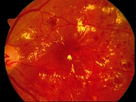 Рисунок 1. Непролиферативная диабетическая ретинопатия, макулопатия