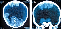 Рис. 6. А, Б. РКТ головного мозга больной Д., 2 мес. Порок развития головного мозга. Двусторонняя разомкнутая шизэнцефалия. Значительное расширение боковых щелей мозга (занимает височные, теменные и большую часть лобных долей), соединяющиеся с боковыми же