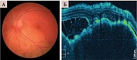 Рис. 5. Офтальмоскопия (A) и томограмма (Б) метастаза в хориоидею