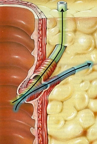 Рис. 4. Рефлюкс дуоденального содержимого в вирсунгов и общий желчный проток на фоне повышения внутриполостного давления в двенадцатиперс