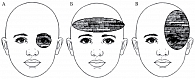 Рис. 2. Локализация разных типов головной боли: А – кластерная; Б – головная боль напряжения; В – мигрень