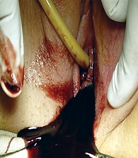 Рис. 5. Хирургическое лечение гематокольпоса: рассечение гимена и опорожнение гематокольпоса