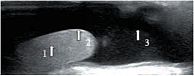 Рис. 4. Эхограмма мошонки ребенка 3 лет с водянкой оболочек яичка. 1 – яичко, 2 – белочная оболочка, 3 – водяночная жидкость
