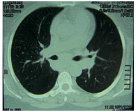 Рис. 6. Клинический случай 2. Увеличенные внутригрудные лимфатические узлы (больше слева) при РКТ у больной саркоидозом