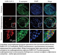 Рис. 1. Иммунофлуоресцентное окрашивание на нуклеокапсидный белок SARS-CoV-2 и E-кадгерин в органоидах протоков печени человека